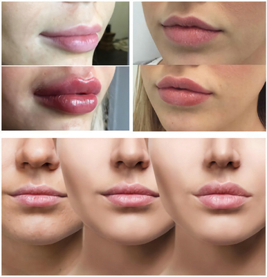 Gładkie Linie / Pulchne Usta Z Kwasem Hialuronowym Wypełniacz Iniekcyjny 1ml 2ml 5ml