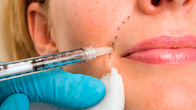 50 ml do wstrzykiwań kwas hialuronowy Dermal Facial Chin Filler With Lidocaine PCL Plla Filler Injection