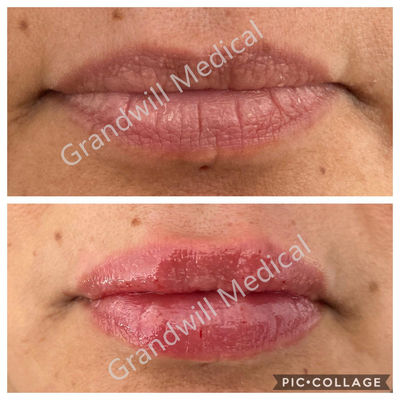Lip Augmentation Wstrzykiwalny żel z kwasem hialuronowym Wypełniacz skórny 1ml 2ml