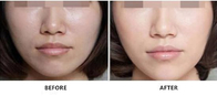 2 ml 2,5 ml Non Cross Linked HA Dermal Filler do rozjaśniania skóry twarzy Anti Aging