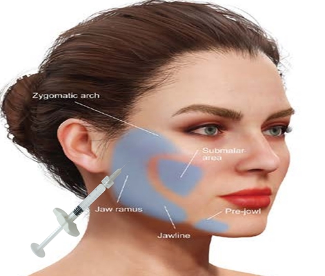 Kwas hialuronowy HA Wypełniacz hydroxypatyt wapniowy uzyskać naturalny wygląd twarzy z 1 ml strzykawki