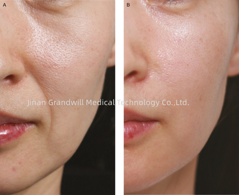 Miracle H L PCL Skin Booster Polycaprolactone Filler do wstrzykiwań kwasu hialuronowego