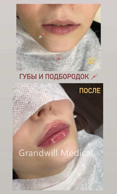 24 mg/ ml Wstrzykiwalny wypełniacz skóry z kwasem hialuronowym do wygładzania zmarszczek
