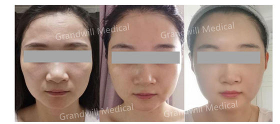 Kwas hialuronowy PCL Skin Booster Miracle Touch Up Stymulator kolagenu skóry
